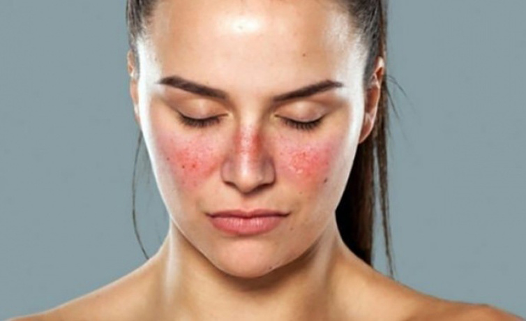 Lupus nedir ciltte döküntülere sebep oluyor!